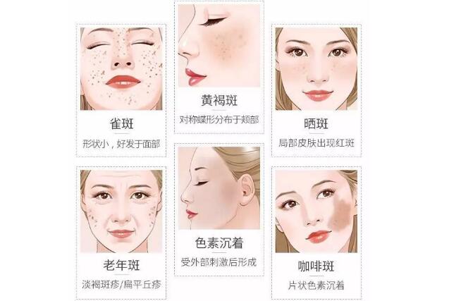色斑也分好多种?看看你脸上是哪种斑