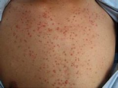 宝宝出现毛囊炎时家长该如何应对?