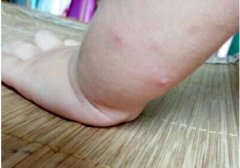 宝宝被传染疥疮都是父母的疏忽!