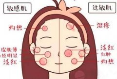 我们为什么会过敏?过敏怎么治?