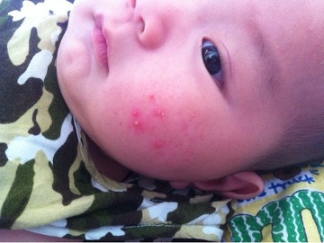 太原专家：治愈宝宝湿疹分清类型很重要