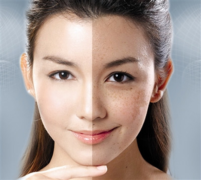 色斑患者如何安然度过夏季?