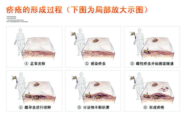 疥疮就一定传染吗?可以过性生活吗?