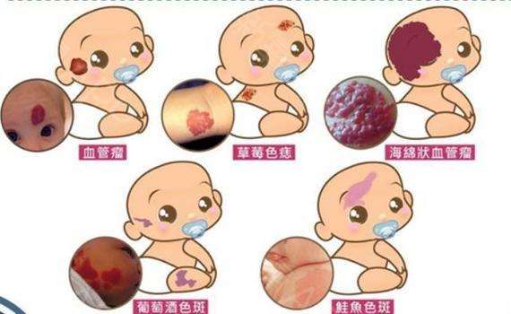 常见的宝宝胎记类型有哪些?
