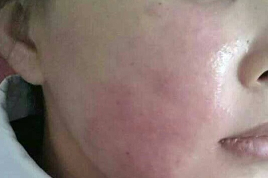 如何才能改变红血丝肌肤?