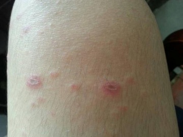 夏季虫咬皮炎该怎么办?如何预防?