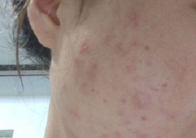 治疗青春痘的方法需要注意什么?