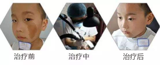 宝宝胎记需要治疗吗?胎记有哪些种类?
