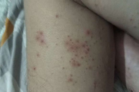疥疮是如何传染的?如何避免疥疮传染?