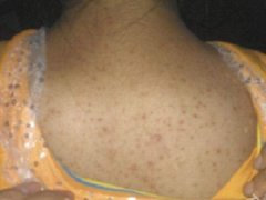 脖子后面的毛囊炎该如何缓解?