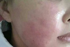 脸上红血丝怎么办?红血丝如何治疗?