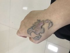 想洗掉纹身可以用哪些方法?