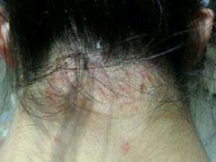 脂溢性皮炎是怎么来的?哪些原因需要注意?