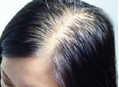 为什么会脱发?脱发该怎么办?