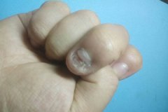 灰指甲那么容易反复发作是因为什么?