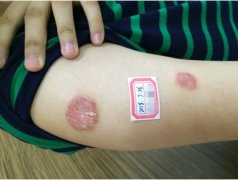 如何有效的预防银屑病牛皮癣的发生?