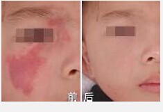 宝宝出现胎记是上天的恩赐还是渡劫?