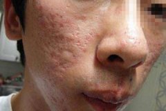 痘痘是一种普遍的炎症性皮肤疾病,由排出来的皮脂腺阻塞形成