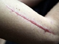 修复痘疤、痘坑的几大注意事项,治痘疤先治痘