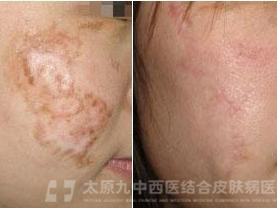 疤痕给患者造成的生理危害,局部出现痒、疼痛感无法忍受