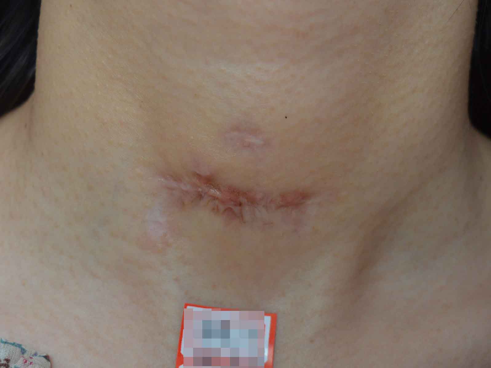 疤痕有什么形成原因?肥厚性疤痕对生活的危害