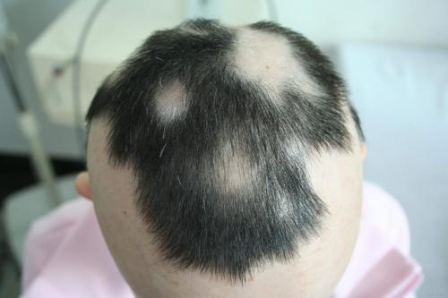 洗头是否会引起脱发?油性头发每天洗头可以吗?