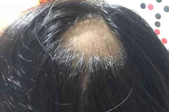 哪些年龄层的人非常容易脱发?成年人脱发最重要的是遗传因素