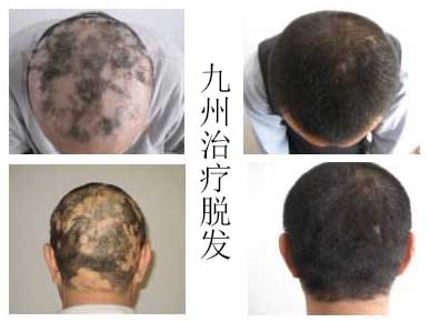 防止出现脱发的合理方式有哪些?怎么梳头发防脱发?