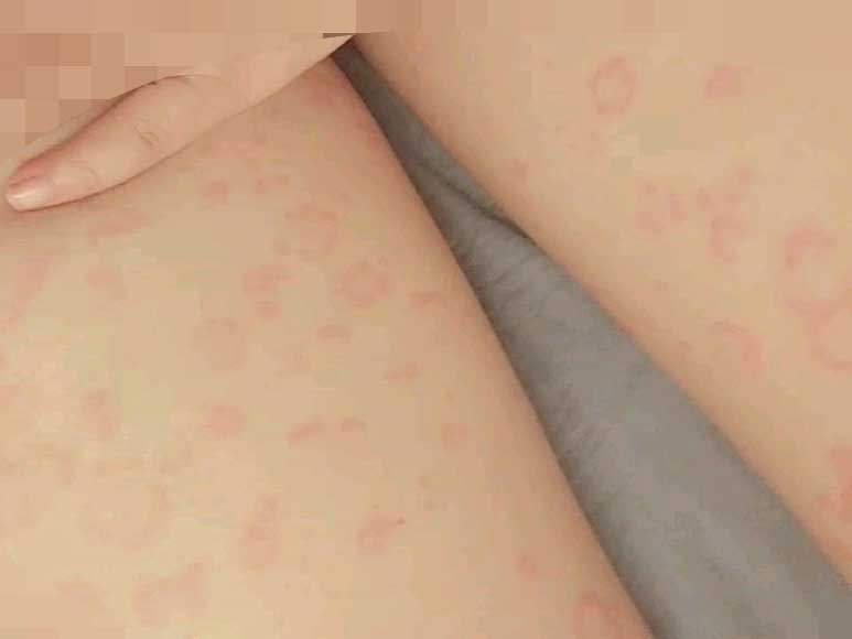 小孩得荨麻疹可以洗澡吗？