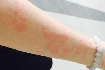 荨麻疹引起水肿:儿童感染性荨麻疹全身水肿