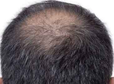 油脂性皮炎脱发了,油脂性皮炎脱发怎么办?