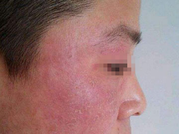 面部脂溢性皮炎症状,面部脂溢性皮炎怎么办?
