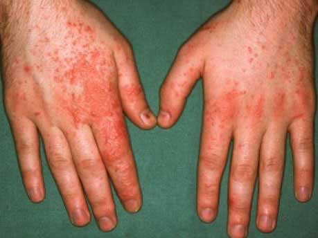 接触性皮炎属于几型变态反应,变态反应性接触性皮炎的治疗